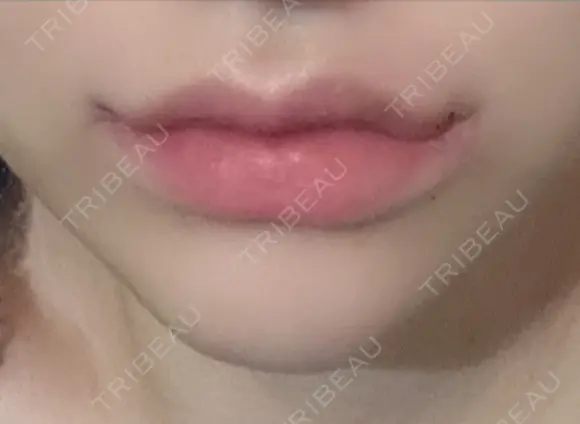 口唇縮小術 / 口角挙上 B-LINE CLINIC 池袋院 DAY 7 メイン用