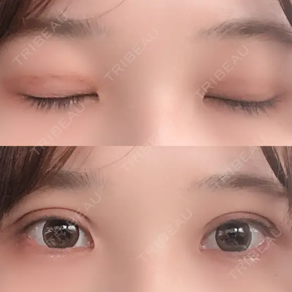 二重埋没 湘南美容クリニック 金沢院 DAY 6 メイン用