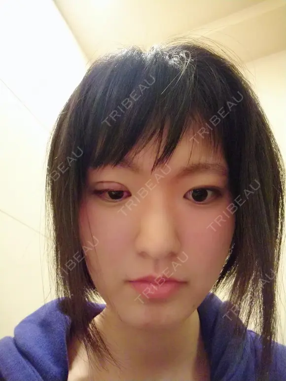 二重埋没 共立美容外科 札幌院 DAY 101 メイン用
