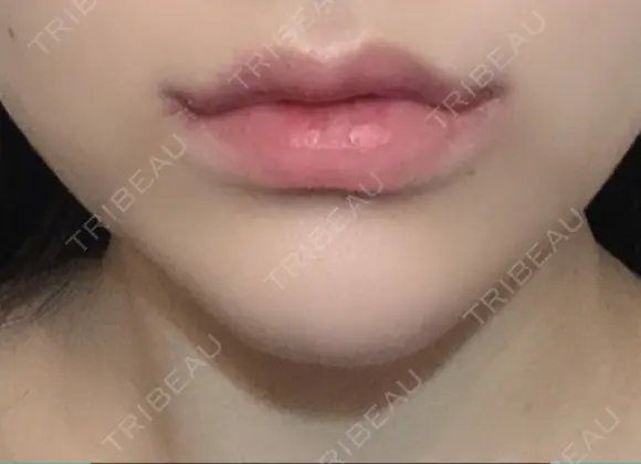 口唇縮小術 / 口角挙上 B-LINE CLINIC 池袋院 DAY 8 メイン用