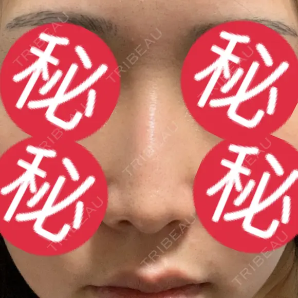 その他（鼻） 聖心美容クリニック 大阪院 AFTER メイン用