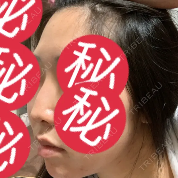 その他（鼻） 聖心美容クリニック 大阪院 DAY 78 メイン用