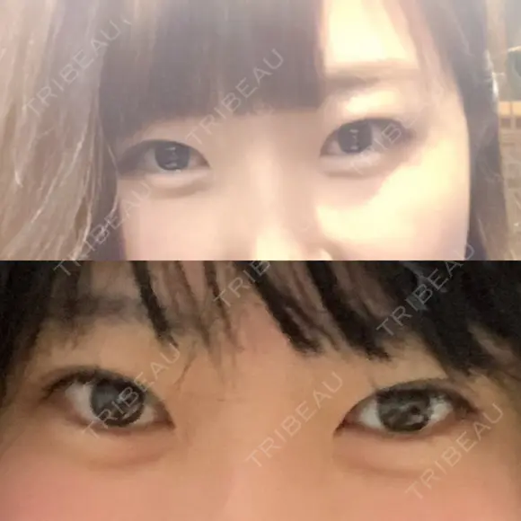 蒙古ひだ形成 R.O.clinic DAY 29 メイン用