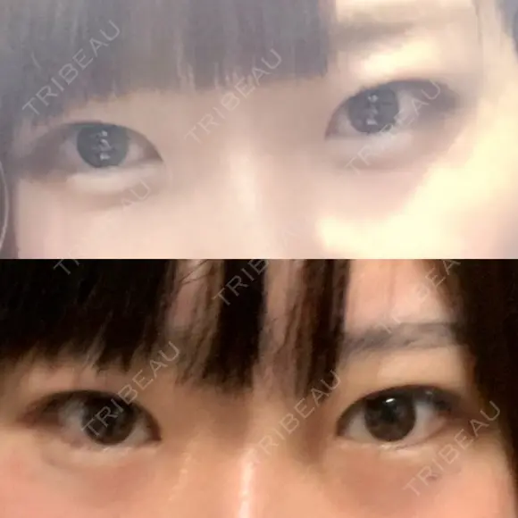蒙古ひだ形成 R.O.clinic DAY 29 メイン用