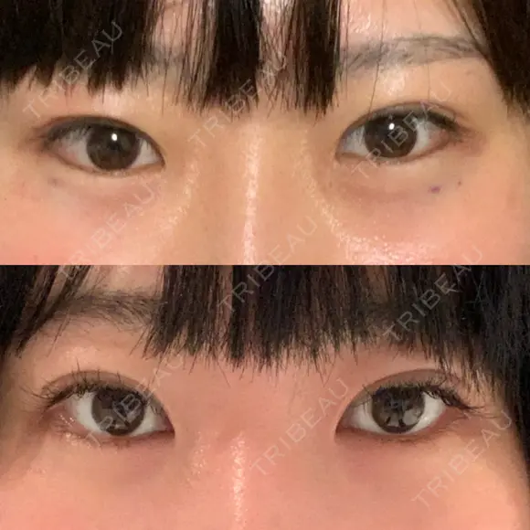 蒙古ひだ形成 R.O.clinic DAY 29 メイン用