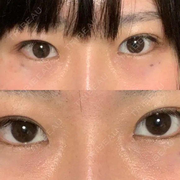 蒙古ひだ形成 R.O.clinic DAY 29 メイン用
