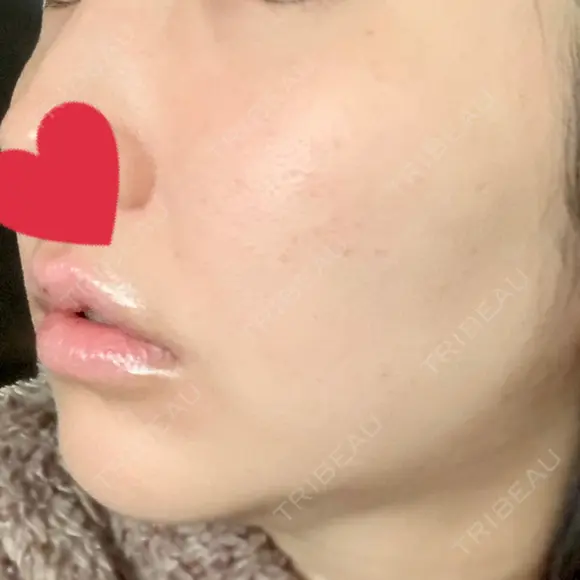 シミ取りレーザー / ピコレーザートーニング（美白・肝斑） UB CLINIC銀座 DAY 14 メイン用