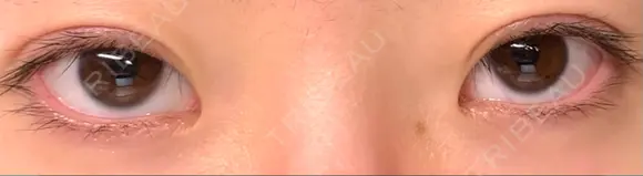 二重切開 郡山タウン形成外科クリニック AFTER メイン用