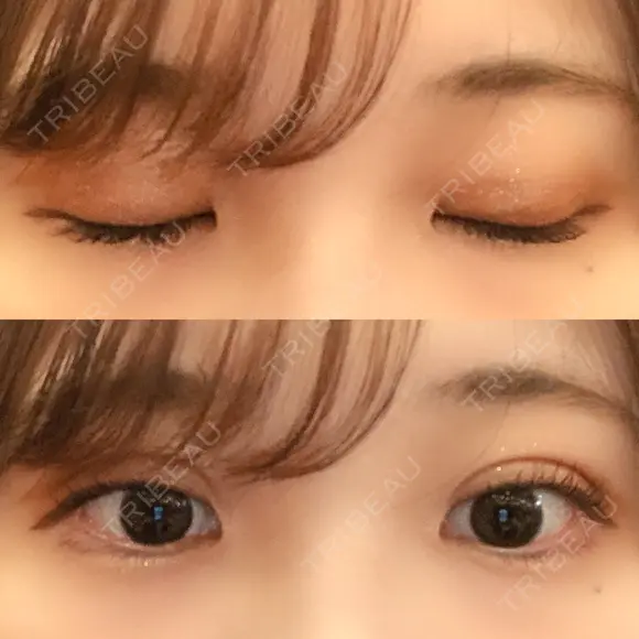 二重埋没 湘南美容クリニック 金沢院 DAY 7 メイン用