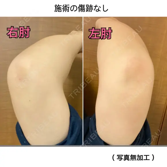 脂肪吸引（二の腕） Mods Clinic（モッズクリニック） 東京院 DAY 190 メイン用