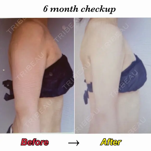 脂肪吸引（二の腕） Mods Clinic（モッズクリニック） 東京院 AFTER メイン用