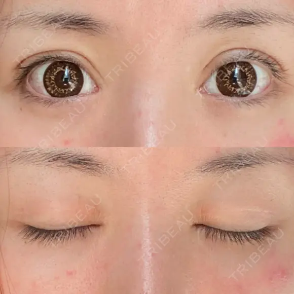 二重切開 / 眼瞼下垂（切開） / 目元修正 シエルクリニック AFTER メイン用