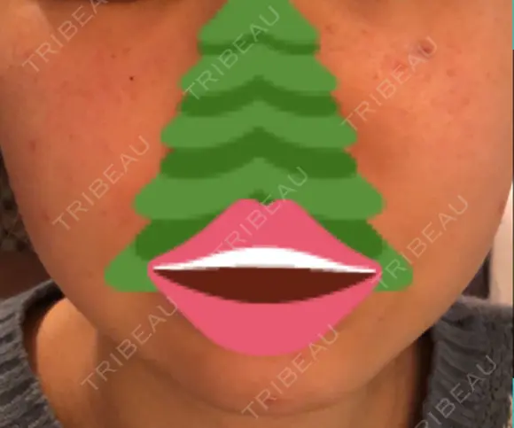 ほくろ・いぼ切除（肌） / ほくろ・いぼ除去レーザー（肌） 赤坂メディカルMクリニック DAY 20 メイン用