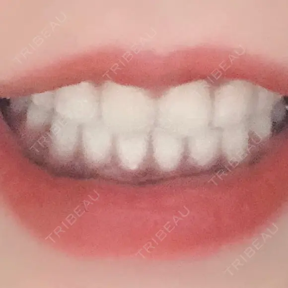 骨切り（あご） / 骨削り（頬） / ガミースマイル手術 / ルフォー+ssro（両あご) ウォンジン（Wonjin）整形外科 DAY 366 メイン用