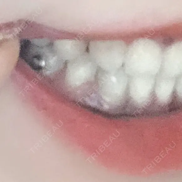 骨切り（あご） / 骨削り（頬） / ガミースマイル手術 / ルフォー+ssro（両あご) ウォンジン（Wonjin）整形外科 DAY 366 メイン用