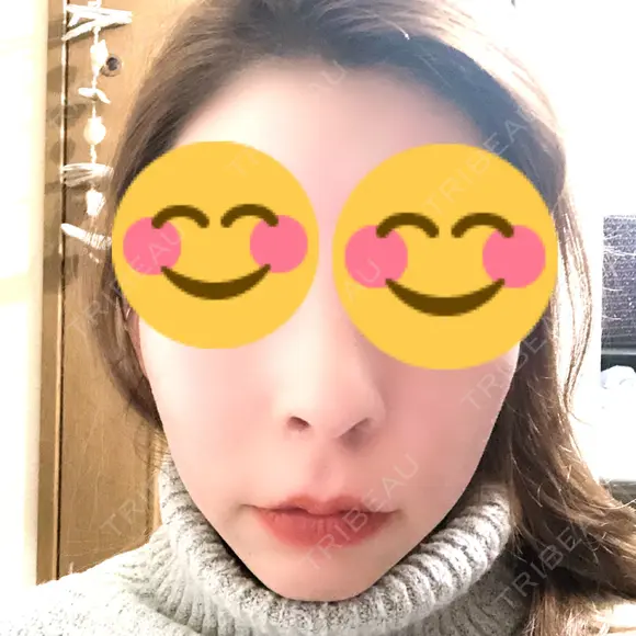 骨切り（あご） / 骨削り（頬） / ガミースマイル手術 / ルフォー+ssro（両あご) ウォンジン（Wonjin）整形外科 AFTER メイン用