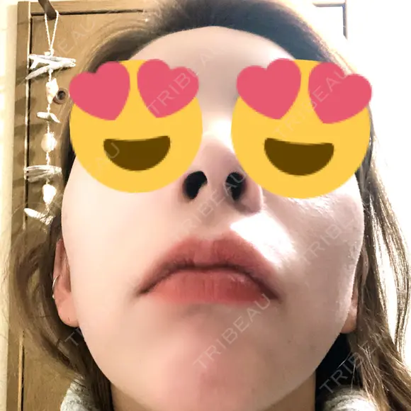 骨切り（あご） / 骨削り（頬） / ガミースマイル手術 / ルフォー+ssro（両あご) ウォンジン（Wonjin）整形外科 DAY 366 メイン用