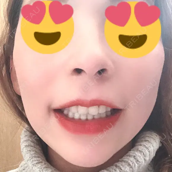 骨切り（あご） / 骨削り（頬） / ガミースマイル手術 / ルフォー+ssro（両あご) ウォンジン（Wonjin）整形外科 DAY 366 メイン用