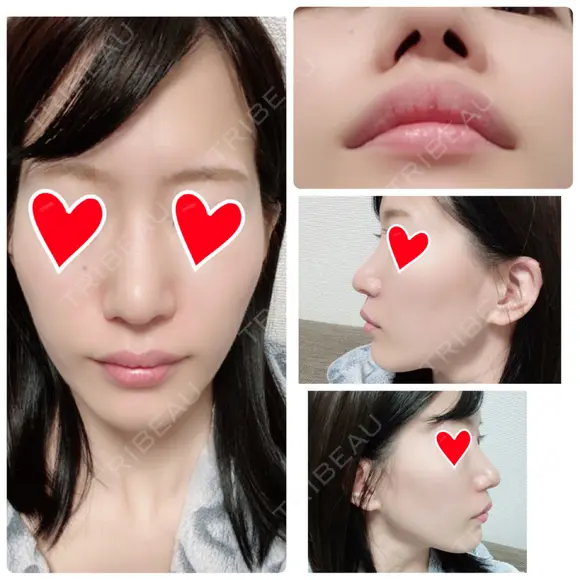 鼻中隔延長（切開） / 軟骨移植 / 鼻修正 / 傷跡修正 神戸大学附属病院 美容外科 AFTER メイン用