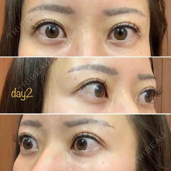 二重埋没 湘南美容クリニック 品川院 DAY 2 メイン用