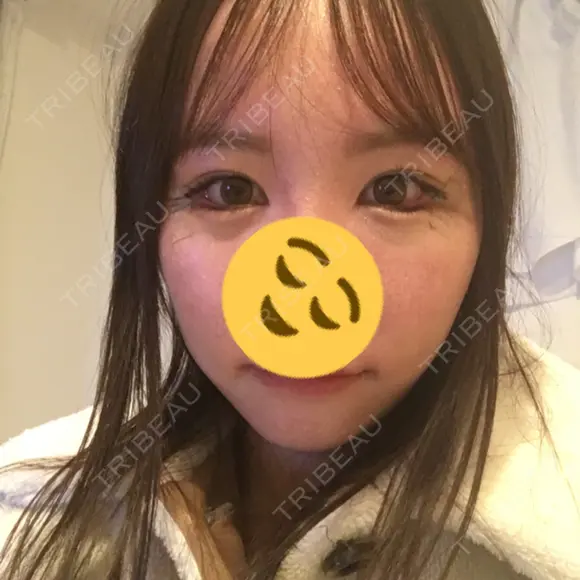 目尻切開 / タレ目形成・グラマラスライン（切開） B-LINE CLINIC 池袋院 DAY 5 メイン用