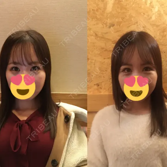 目尻切開 / タレ目形成・グラマラスライン（切開） B-LINE CLINIC 池袋院 DAY 5 メイン用