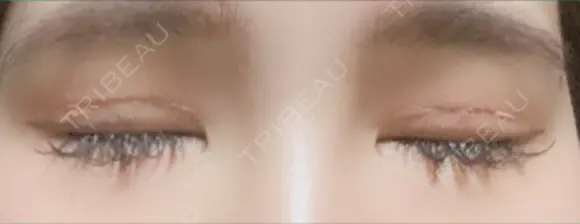 二重切開 松下皮フ形成外科 DAY 6 メイン用