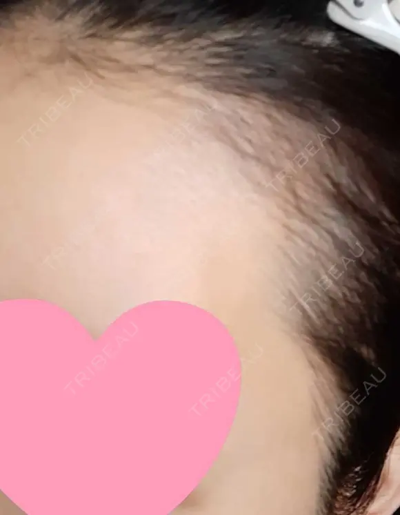 アートメイク（ヘアライン） トイトイトイクリニック 池袋院 DAY 16 メイン用