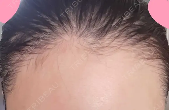 アートメイク（ヘアライン） トイトイトイクリニック 池袋院 DAY 17 メイン用