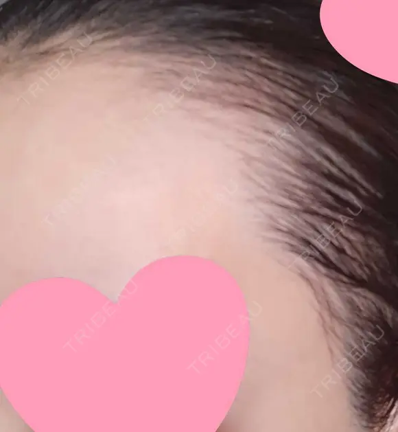 アートメイク（ヘアライン） トイトイトイクリニック 池袋院 DAY 17 メイン用