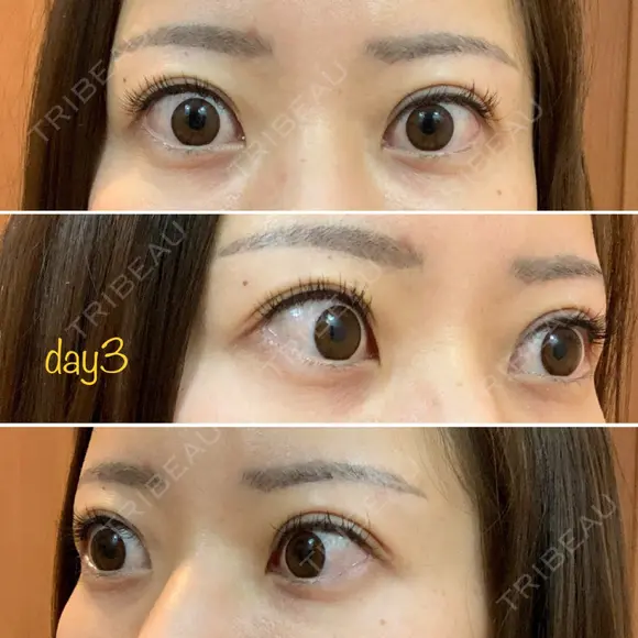 二重埋没 湘南美容クリニック 品川院 DAY 3 メイン用