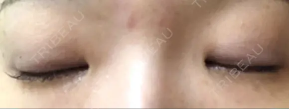 二重埋没 湘南美容クリニック 熊本院 DAY 15 メイン用