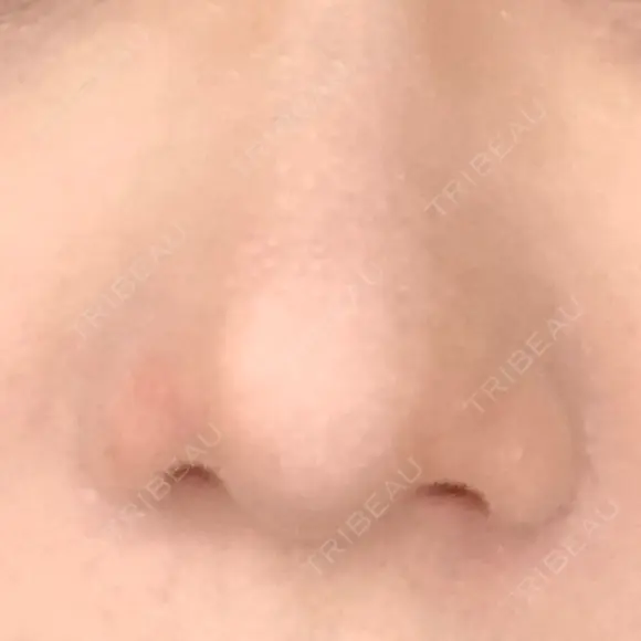 鼻尖形成（切開） / 軟骨移植 白山クリニック 大分 DAY 31 メイン用