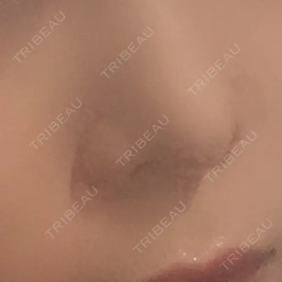 鼻尖形成（切開） / 軟骨移植 白山クリニック 大分 DAY 33 メイン用