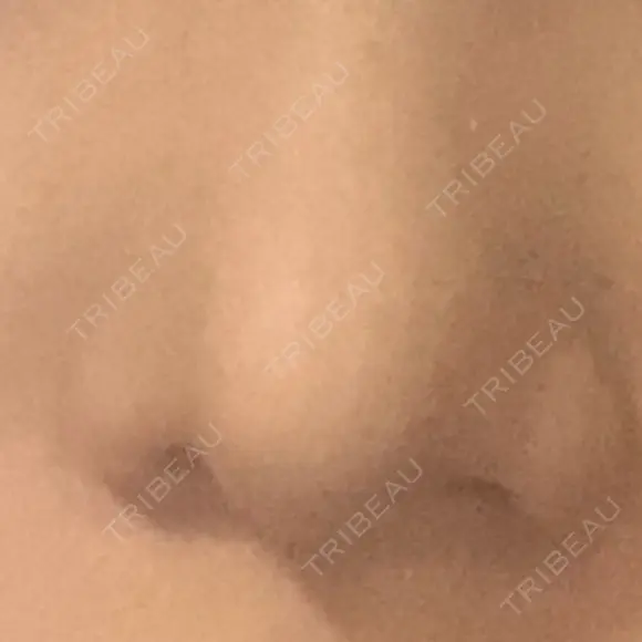 鼻尖形成（切開） / 軟骨移植 白山クリニック 大分 DAY 33 メイン用