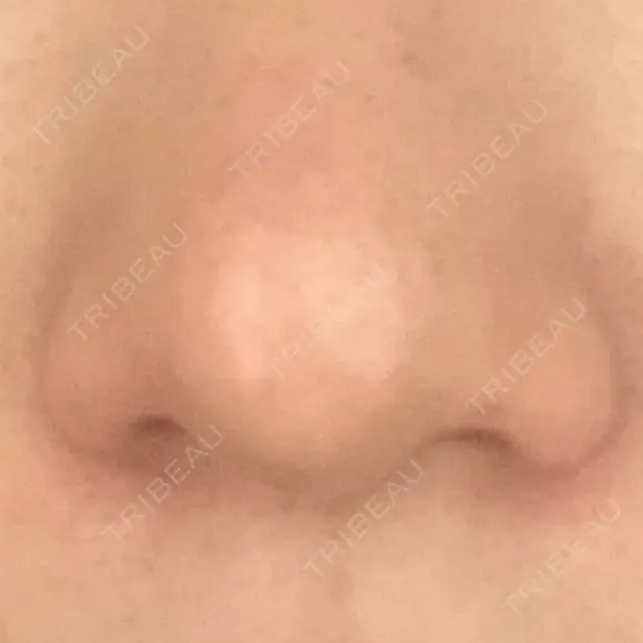 鼻尖形成（切開） / 軟骨移植 白山クリニック 大分 DAY 36 メイン用