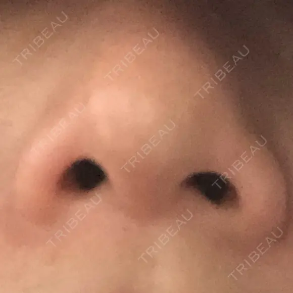 鼻尖形成（切開） / 軟骨移植 白山クリニック 大分 DAY 36 メイン用