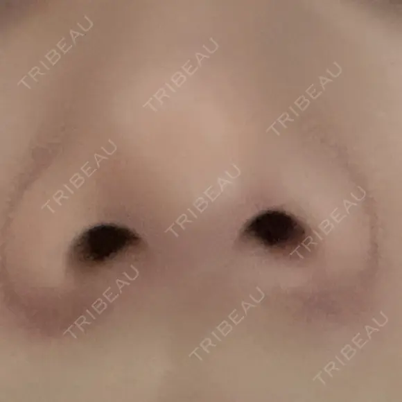 鼻尖形成（切開） / 軟骨移植 白山クリニック 大分 AFTER メイン用