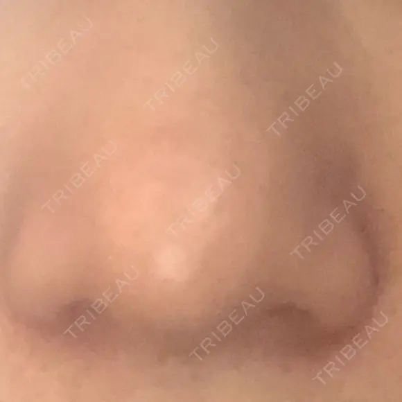 鼻尖形成（切開） / 軟骨移植 白山クリニック 大分 DAY 43 メイン用