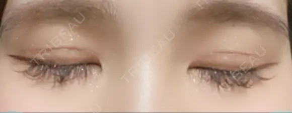 二重切開 松下皮フ形成外科 DAY 8 メイン用