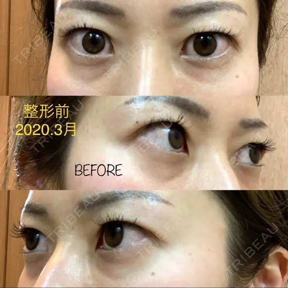 二重埋没 湘南美容クリニック 品川院 DAY 5 メイン用