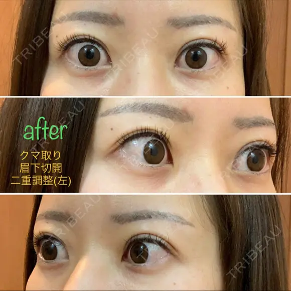 二重埋没 湘南美容クリニック 品川院 AFTER メイン用