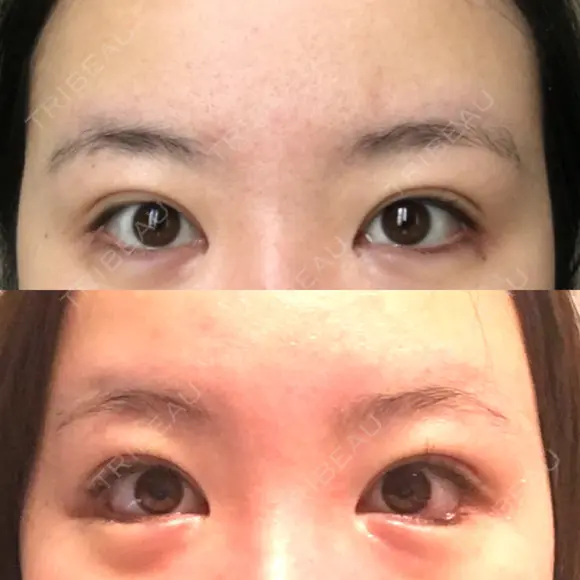 目尻切開 / タレ目形成・グラマラスライン（切開） B-LINE CLINIC 池袋院 DAY 8 メイン用