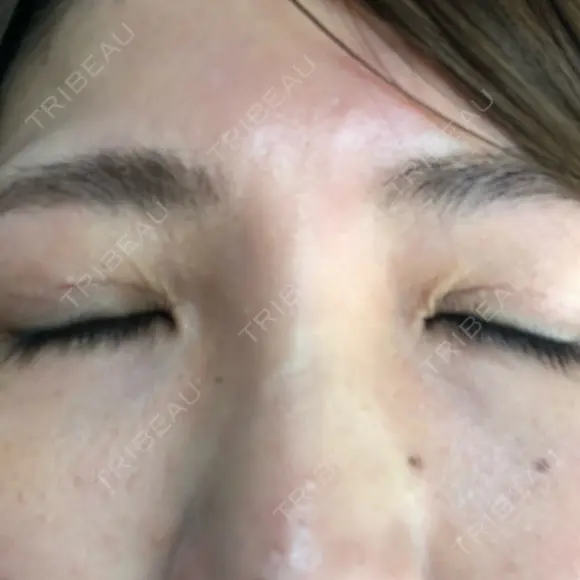 二重切開 / 眼瞼下垂（切開） / 上まぶたたるみ取り 湘南美容クリニック 高田馬場院 DAY 48 メイン用