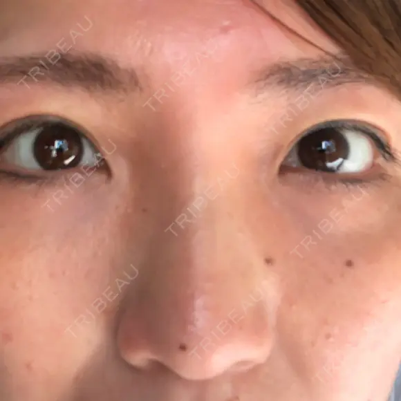 二重切開 / 眼瞼下垂（切開） / 上まぶたたるみ取り 湘南美容クリニック 高田馬場院 DAY 48 メイン用