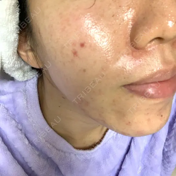 ニキビ治療 アサイクリニック 心斎橋本院 DAY 115 メイン用