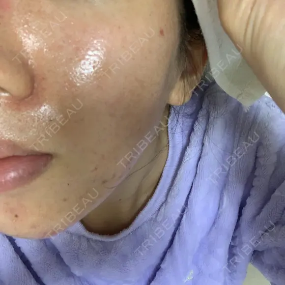 ニキビ治療 アサイクリニック 心斎橋本院 DAY 115 メイン用