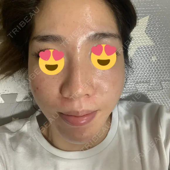 ダーマペン 表参道スキンクリニック 名古屋院（DAILY SKIN CLINIC提携院） DAY 0 メイン用