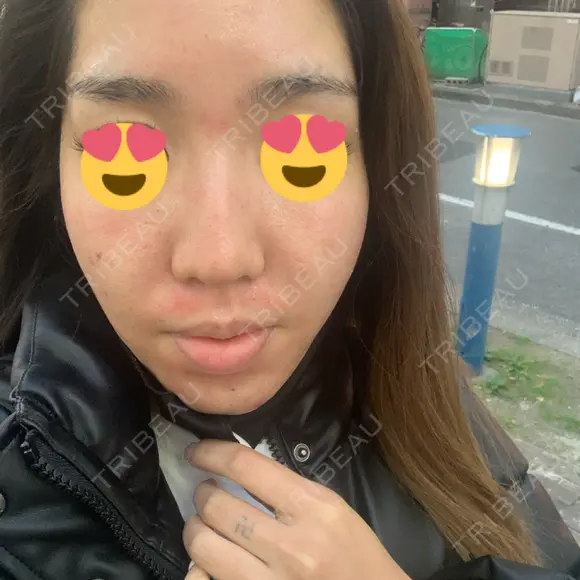 ダーマペン 表参道スキンクリニック 名古屋院（DAILY SKIN CLINIC提携院） DAY 0 メイン用