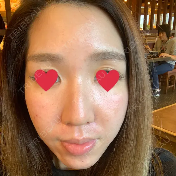 ダーマペン 表参道スキンクリニック 名古屋院（DAILY SKIN CLINIC提携院） AFTER メイン用